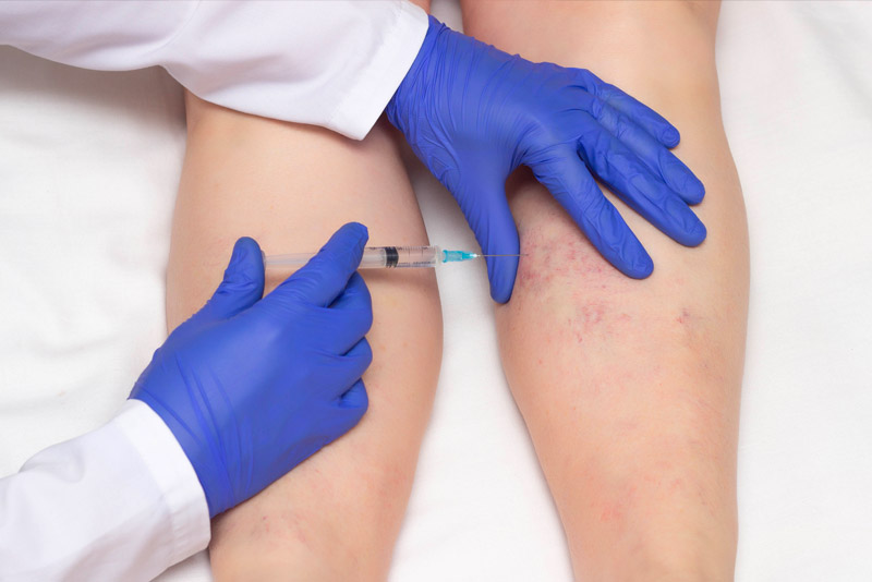 Avail Best Quality Spider Veins Treatment In Queens, NYC At Affordable Rates