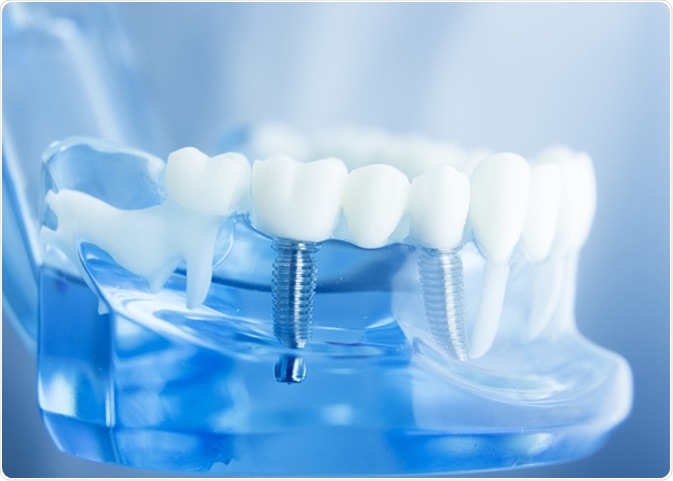 dental implants Essex