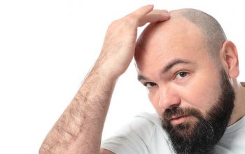 Hair Transplantation as the Best Hair Restoration Technique